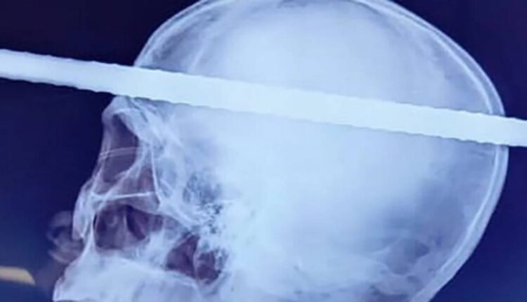 Ακτινογραφία