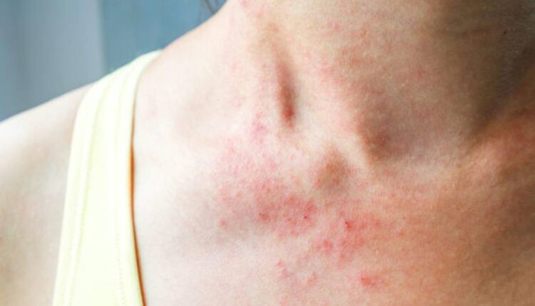 Δέρμα προβλήματα