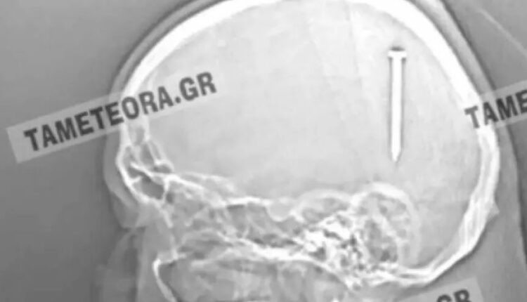 Καρφί σε κεφάλι ανθρώπου στην Καλαμπάκα